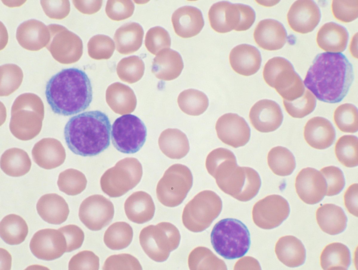 Chronic_lymphocytic_leukemia